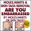 Moles, Warts & Skin Tags Removal